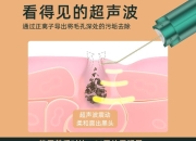 毛孔堵塞怎么清理全是闭口粉刺(HUAWEI HiLink超声波黑头铲美容仪器脸部毛孔清洁去粉刺吸出神器【包邮】)